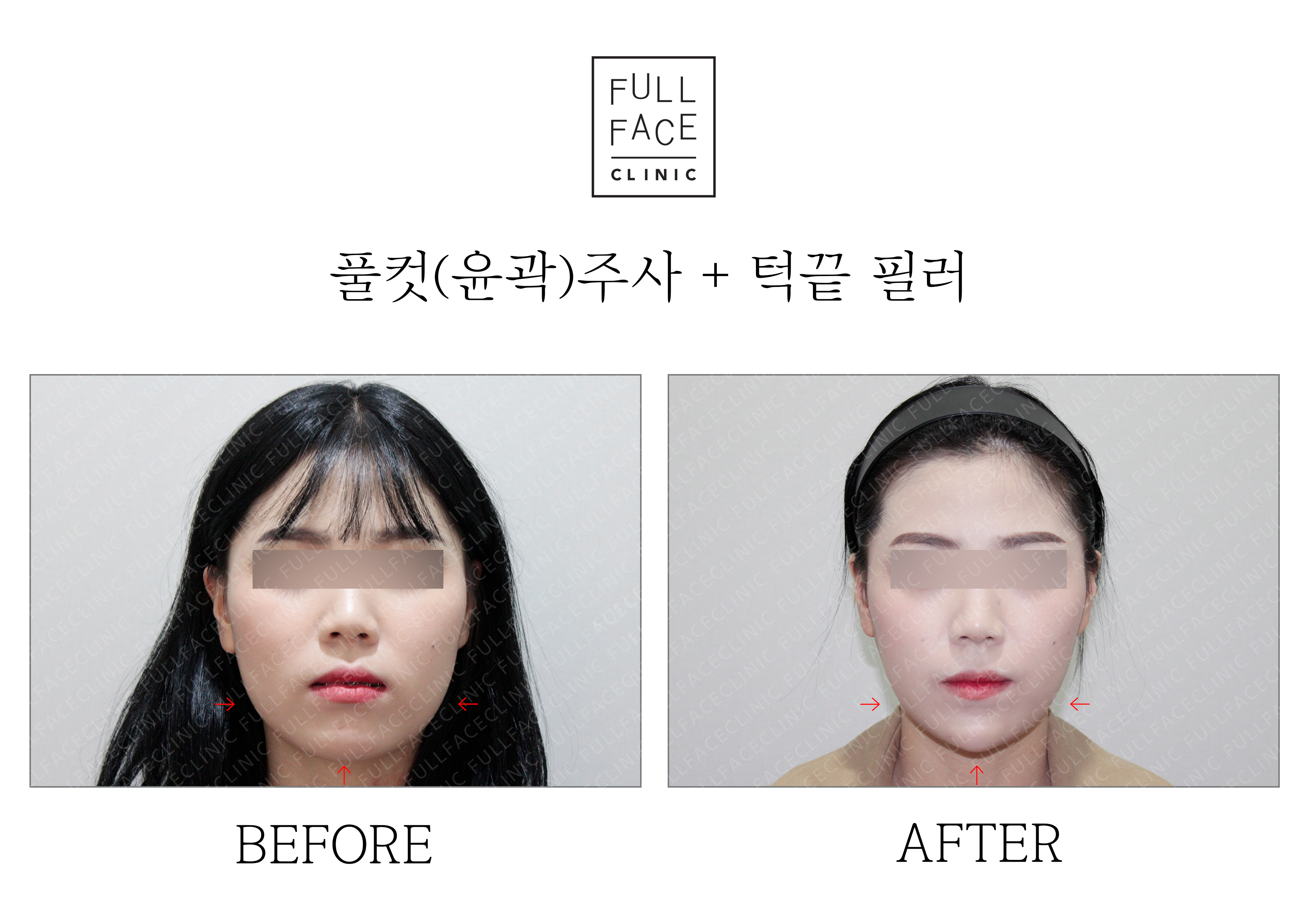 윤곽주사 턱끝필러 전후사진
