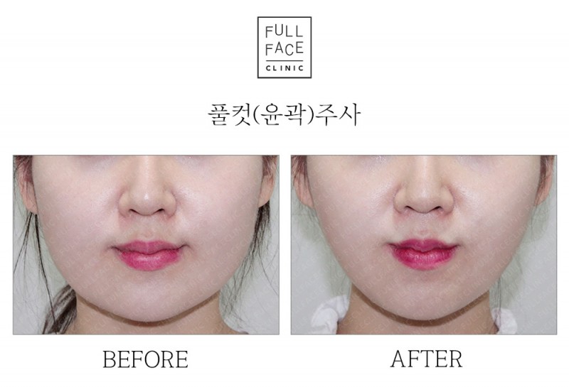 윤곽주사(19.8.26→19.9.9)