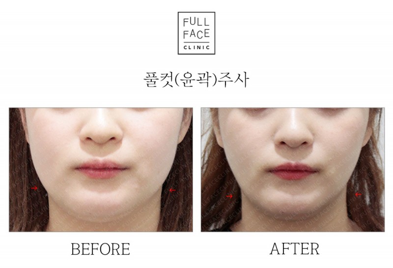 윤곽주사(19.5.31→19.7.3)