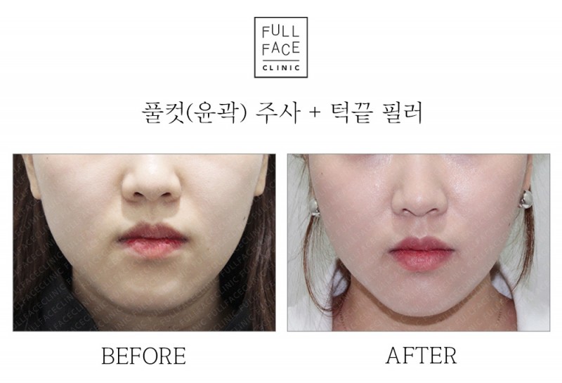 윤곽주사(19.6.1→19.10.5)