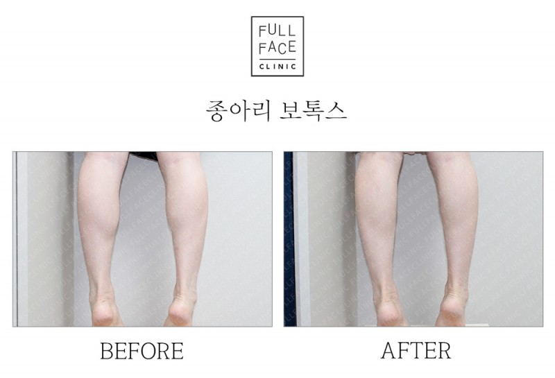 종아리보톡스(19.8.6→19.9.4)