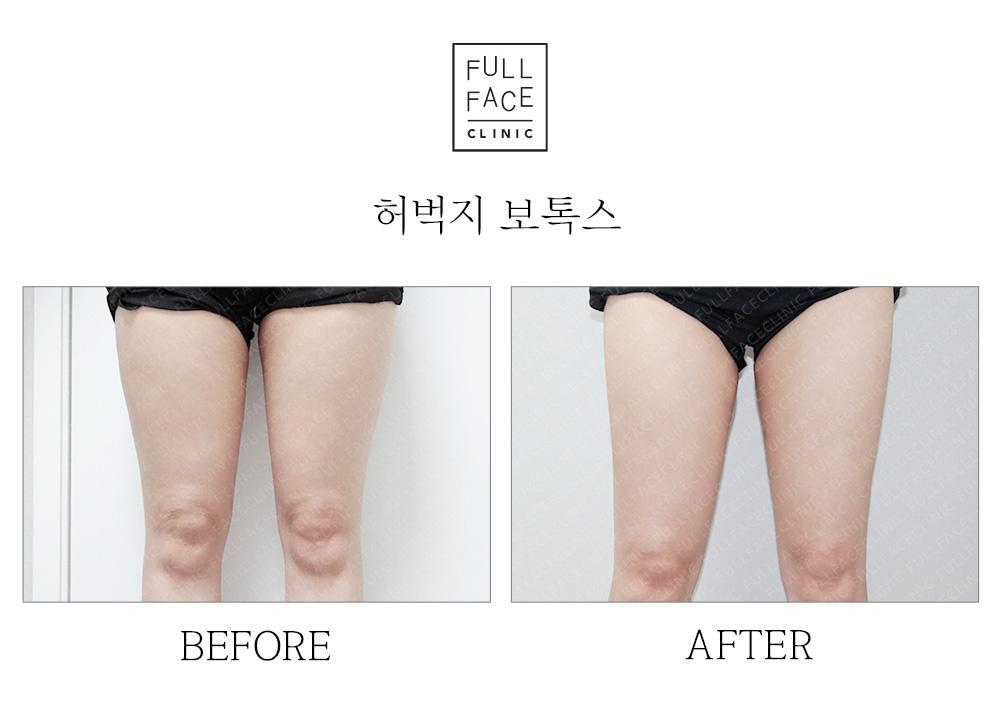 허벅지보톡스(19.6.14→19.8.2)