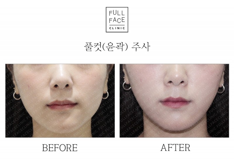 윤곽주사(19.6.13→19.8.2)