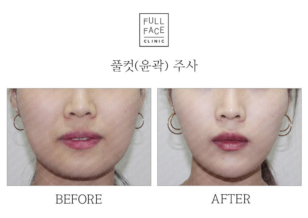 윤곽주사(19.7.26→19.11.27)
