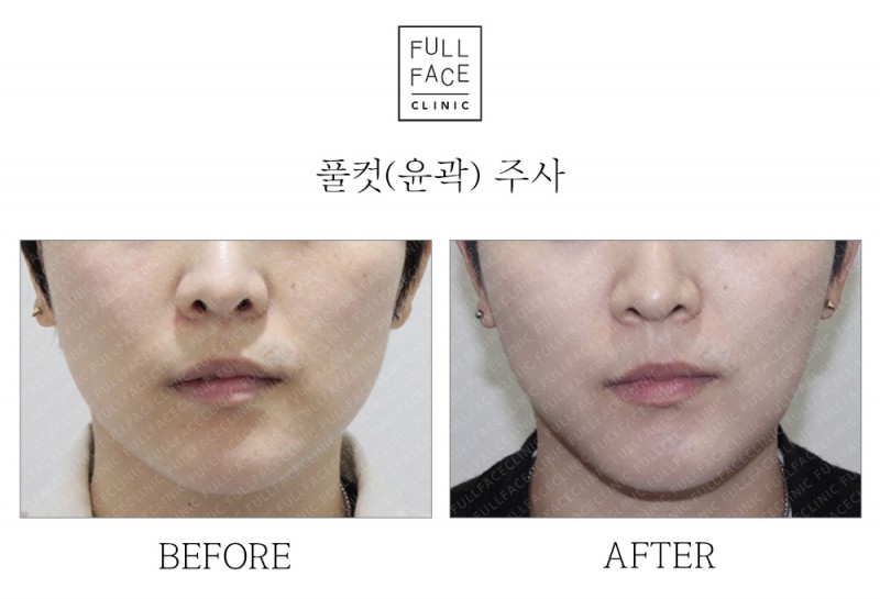 윤곽주사(19.6.15→19.6.26)