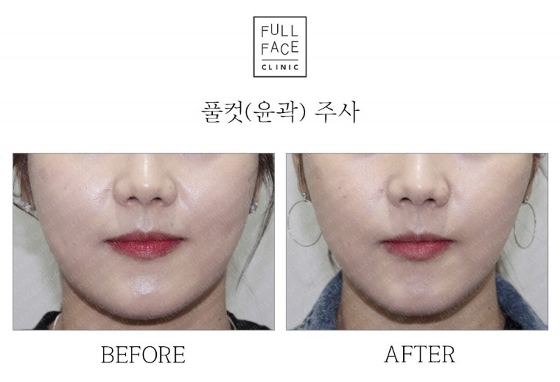 윤곽주사(19.10.12→19.10.26)