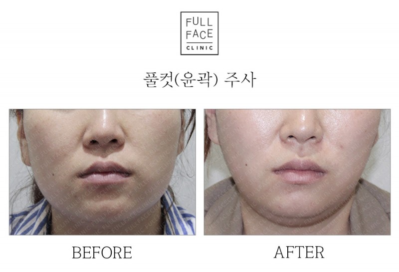 윤곽주사(19.6.7→19.9.26)