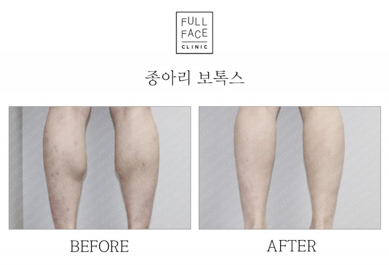 종아리보톡스(20.2.2→20.3.21)
