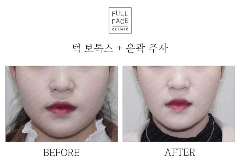 턱보톡스+풀컷주사(20.3.23→20.4.6)