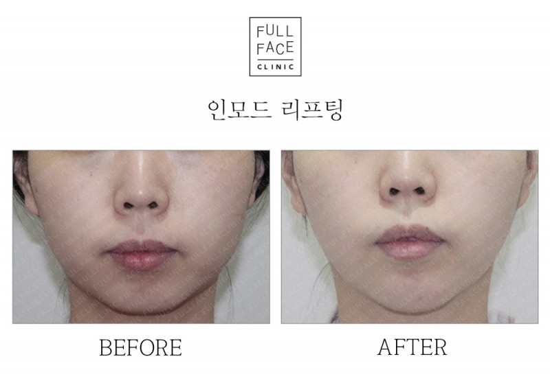 인모드 리프팅(20.3.19→20.4.18)