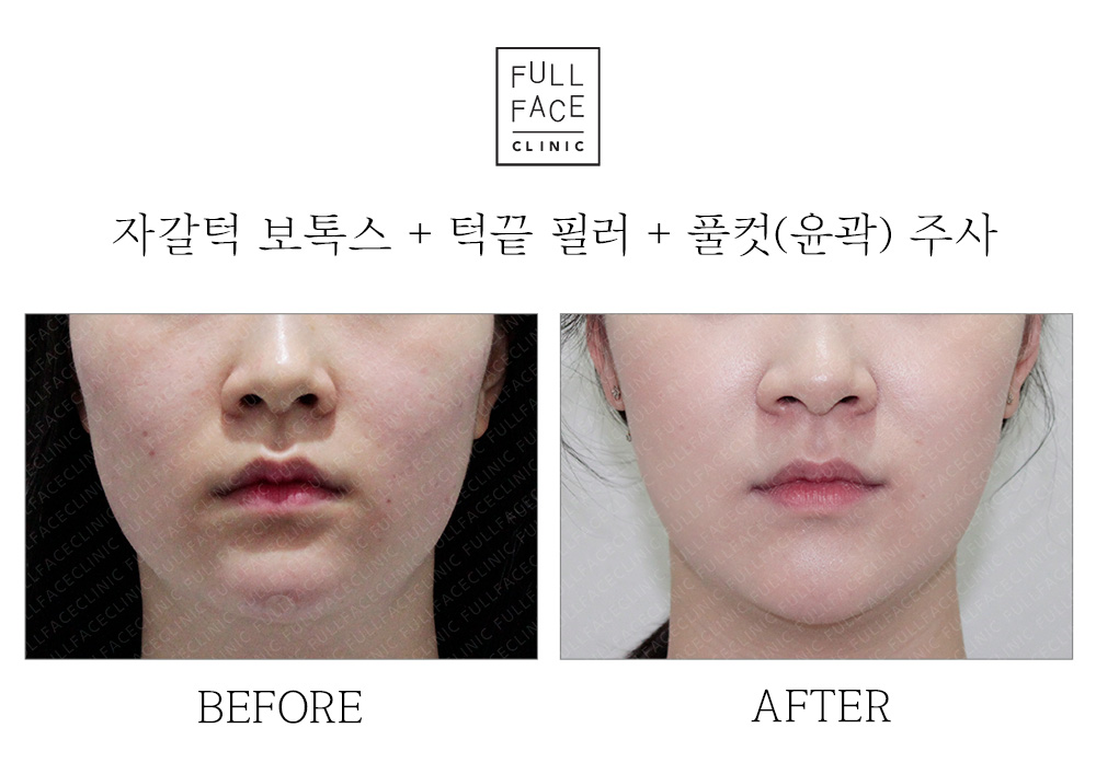 자갈턱+턱끝+윤곽주사(19.6.15→19.7.27)