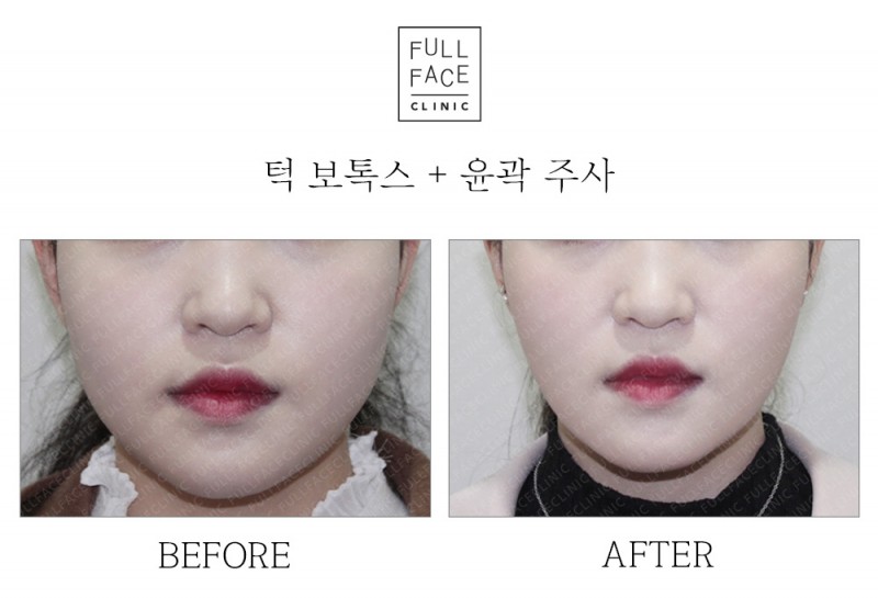 턱보톡스+윤곽주사(20.3.23→20.4.6)