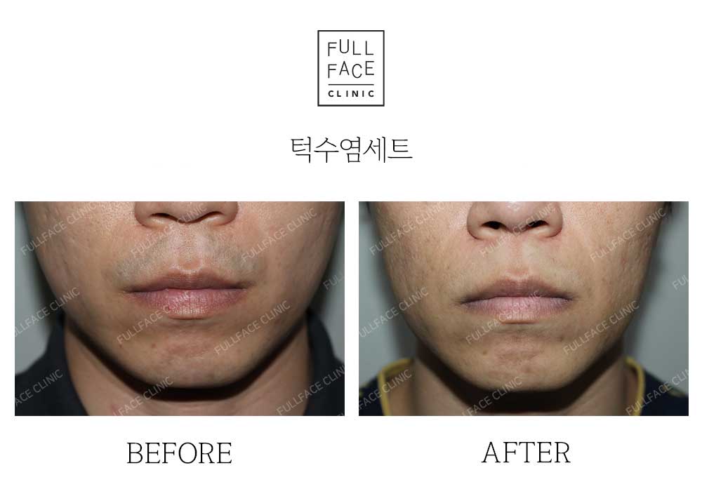 턱수염세트제모(22.6.22→22.9.27)