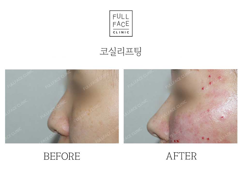 시그니처올림포스코프팅(24.9.11.4→24.11.11)