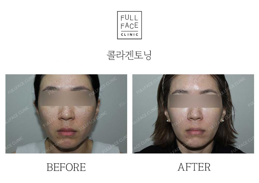 시그니처 콜라겐토닝(24.9.11→24.10.22)