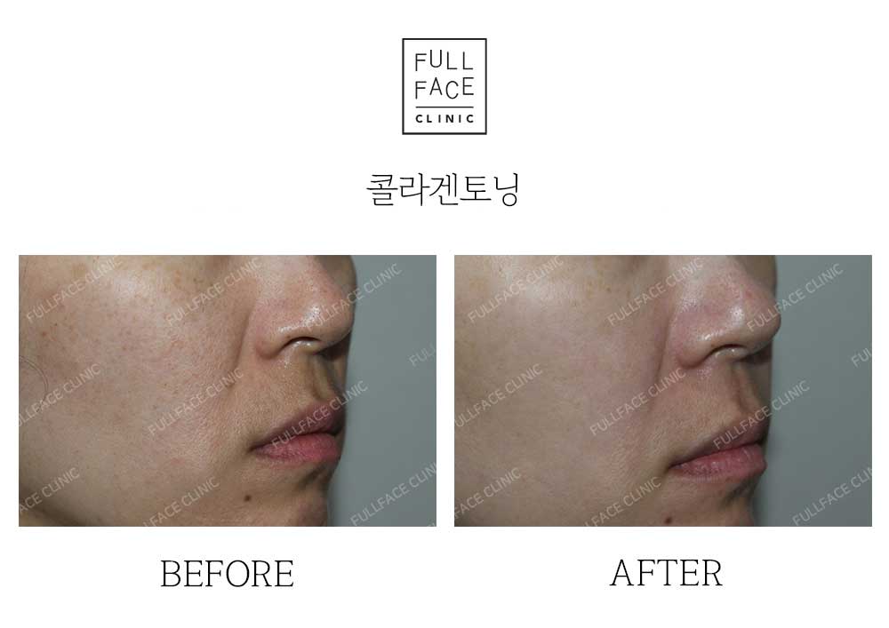 시그니처 콜라겐토닝(24.9.11→24.10.22)
