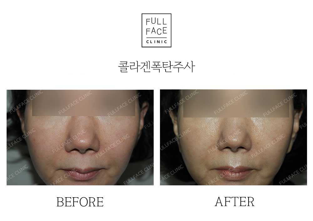 시그니처 콜라겐폭탄주사(24.6.27→24.9.24)