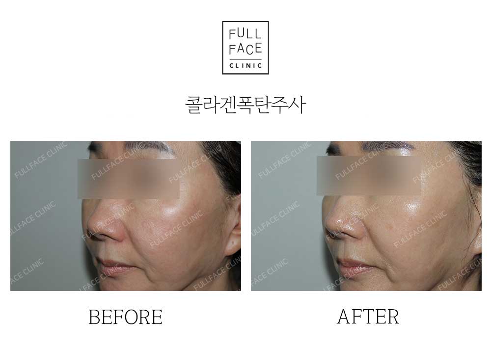 시그니처 콜라겐폭탄주사(24.6.27→24.9.24)