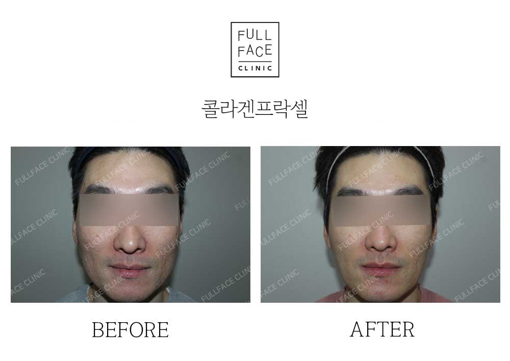 시그니처 콜라겐프락셀(24.1.13→24.6.1)