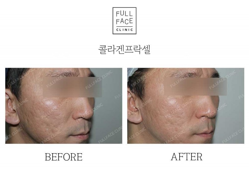 시그니처 콜라겐프락셀(24.1.13→24.6.8)