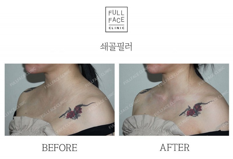 시그니처 스페셜 쇄골필러(25.5.25→시술직후)