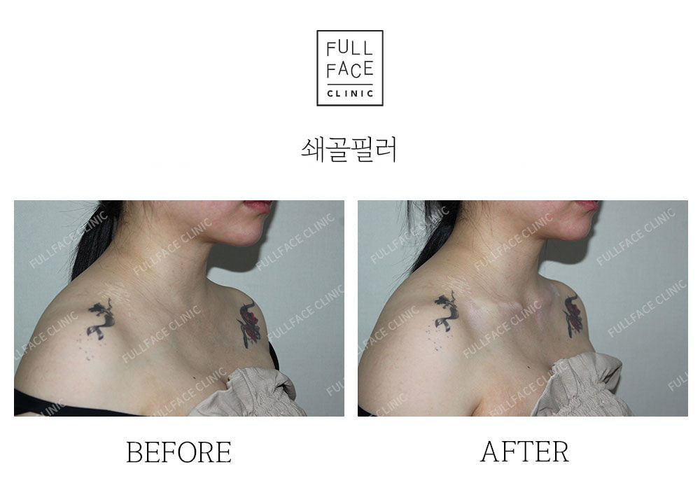 시그니처 스페셜 쇄골필러(25.5.25→시술직후)