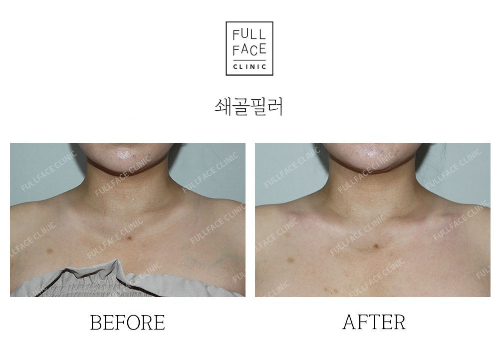 시그니처 스페셜 쇄골필러(25.5.15→시술직후)