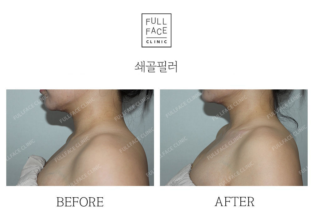 시그니처 스페셜 쇄골필러(25.5.15→시술직후)