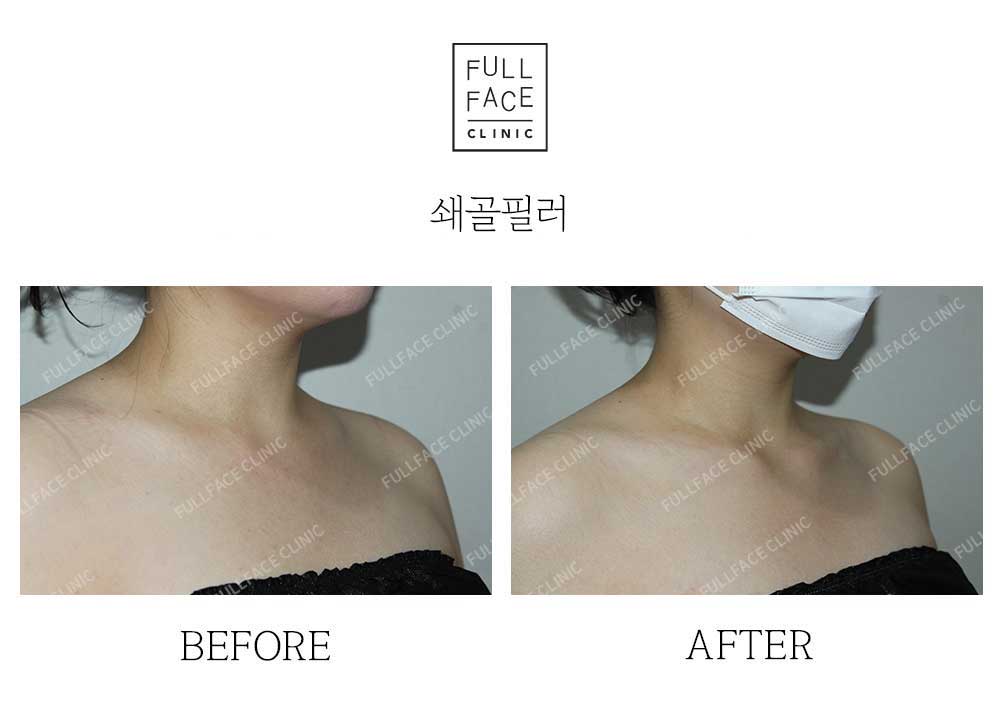 시그니처 스페셜 쇄골필러(25.5.3→시술직후)