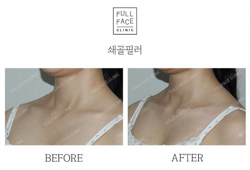 시그니처스페셜쇄골필러(25.5.25→시술직후)