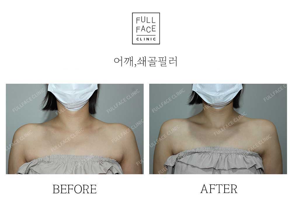 시그니처스페셜 쇄골+어깨필러(25.9.8→25.10.2)