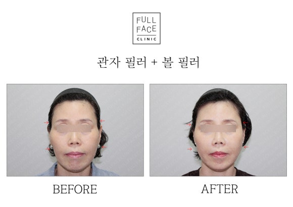 관자놀이 필러 전후 궁금하시다면